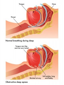 Sleep Apnea 