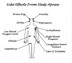 Sleep Apnea 